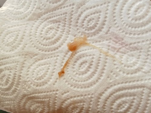 ตั้งครรภ์34+3