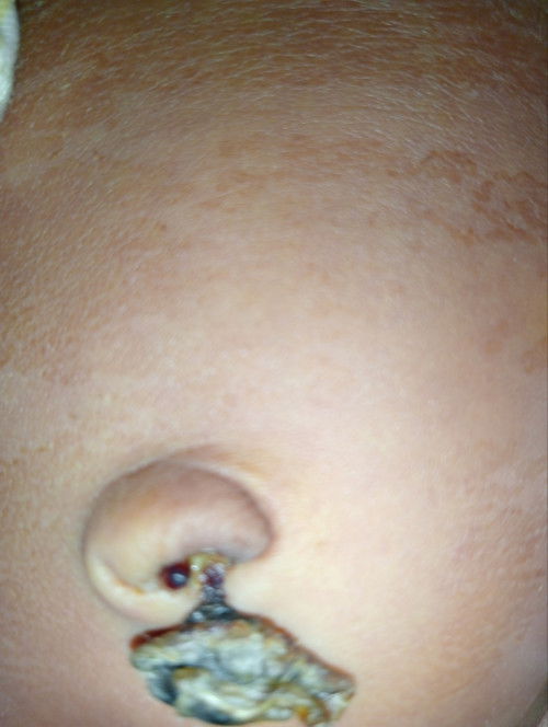 แม่ๆค่ะคือน้องมีเหมือนติ่งเนื้อโผล่ออกมาแบบนี้อันตรายมั้ยคะ