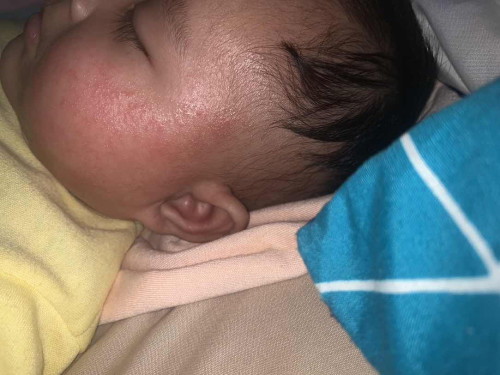 Ruam dan gatal pada bayi