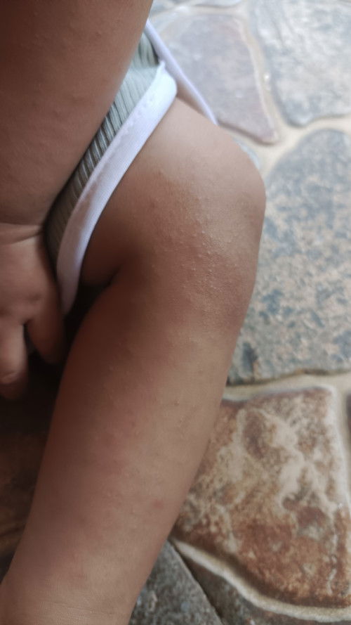 Bun ada yang sama gak pas udah panas jadi keluar bintik"