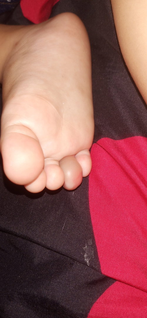 Jari kaki bengkak seperti berair