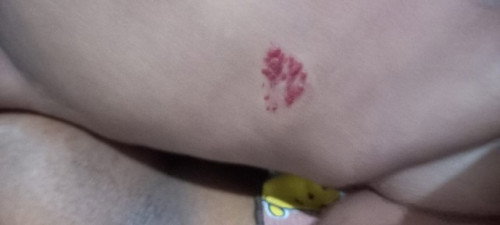 Tanda merah pada tubuh bayi