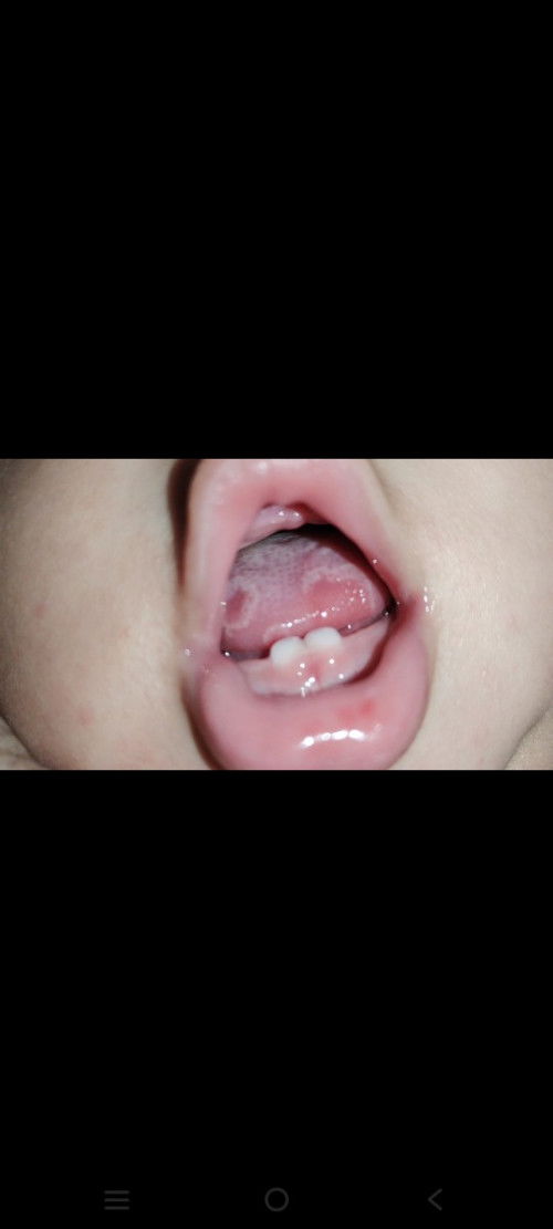 Ada yang pernah ngalamin lidah anaknya seperti difoto?