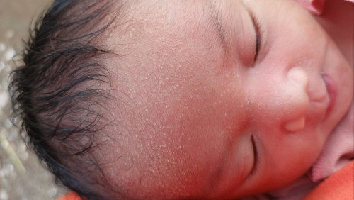 Bintik putih pada bayi