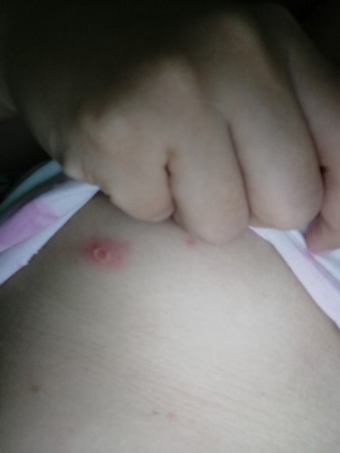 Butlig chicken pox