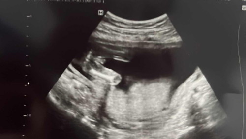 Gender baby