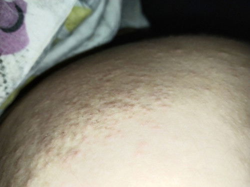 แม่ๆท่านไหนเป็นแบบนี้บ้างคะ บ้านนี้เป็นมา3เดือนแล้วยังไม่หาย ต้องทายาอะไรคะเริ่มเป็นตอนท้องได้8เดือน