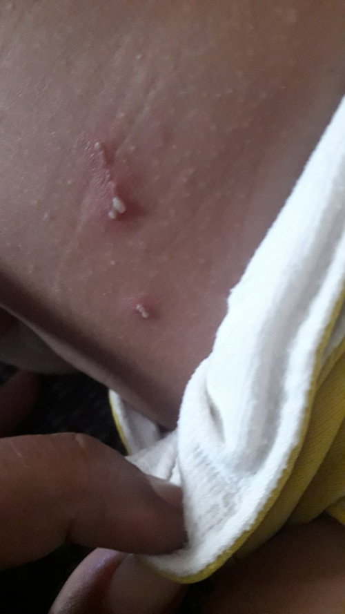 Muncul benjolan di perut