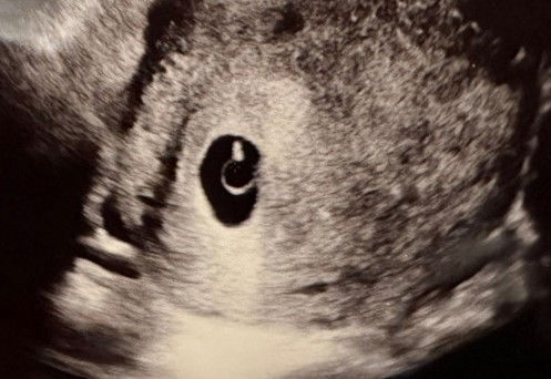 ภาพอัลตราซาว 6W คุณแม่ท่านอื่นเป็นเหมือนกันไหมคะ ปกติไหมค่ะ