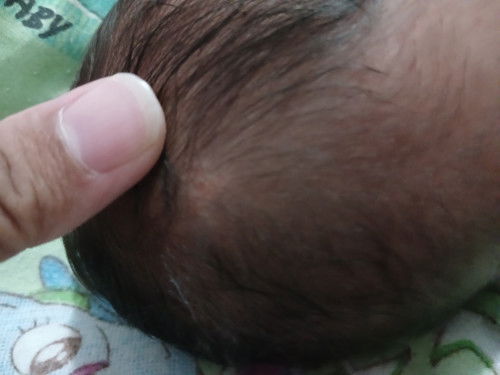 Bintik di kepala bayi baru lahir