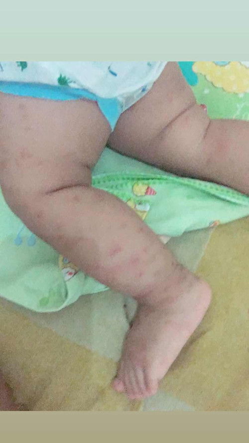 Bekas gigitan nyamuk