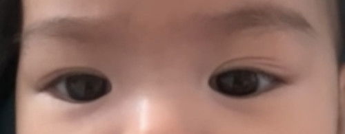 กลุ้มใจลูกชั้นตาไม่เท่ากัน 2ชั้นข้าง 3ชั้นข้าง  (มีรูป)