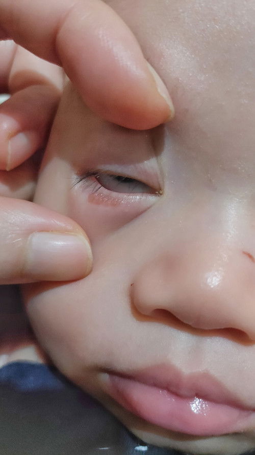 Ruam merah di kelopak bawah mata bayi 4 bulan