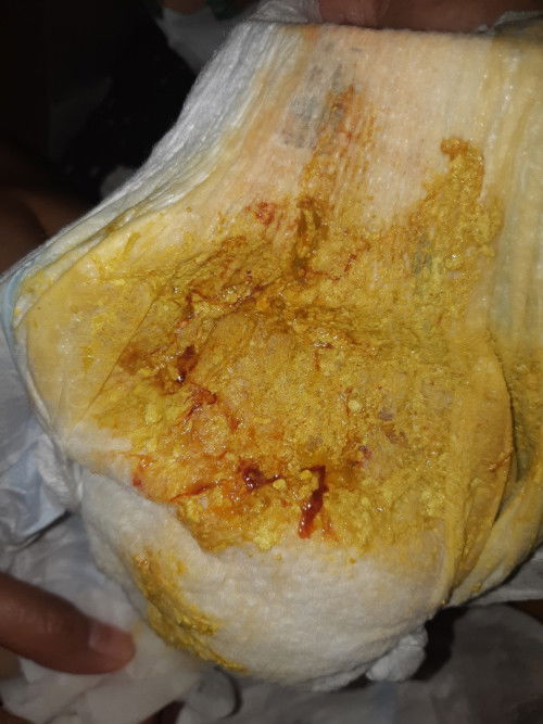 Mucusy blood sa poop