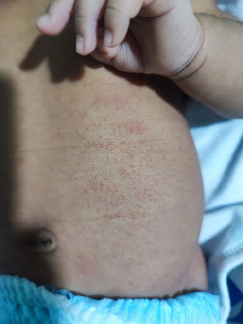 ผดผื่นแบบนี้อันตรายไหมคะ