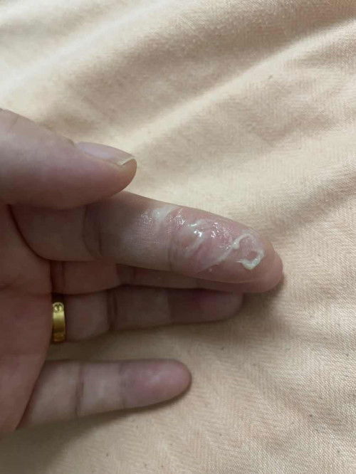 Cecair lendir kuning cair normal ke?