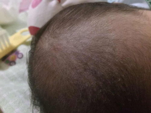 Kulit kepala bayi seperti berketombe