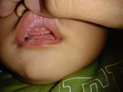 Bunda2 ada yang tau, ini bibir anak aku knp ya? Sariawan atau efek ASI ya
Dia full ASI.