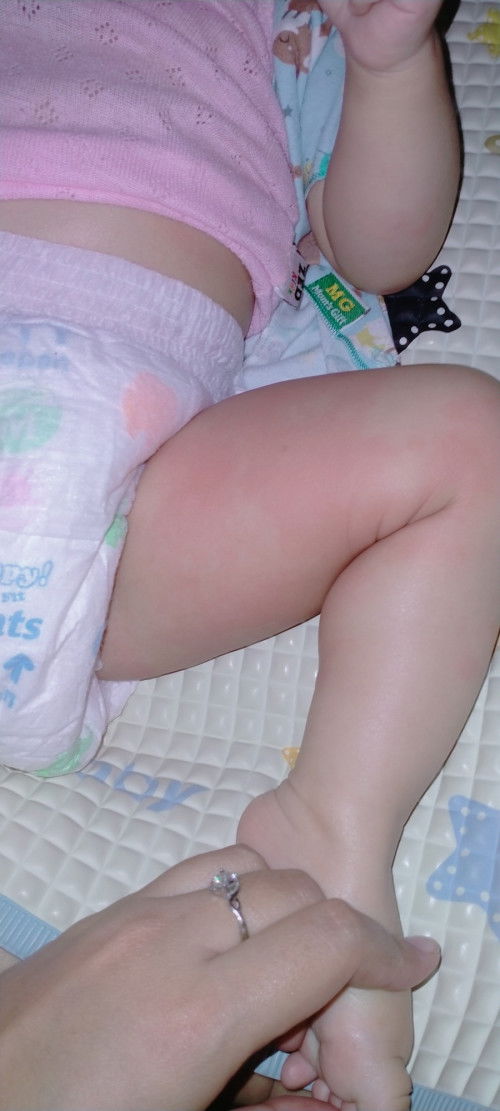 Badan anak merah merah