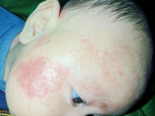 Merah diwajah bayi