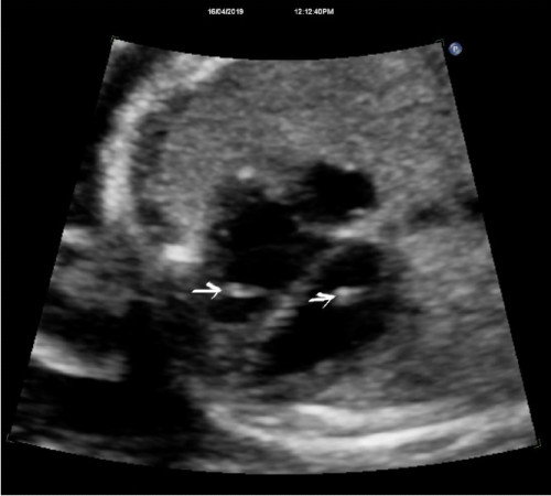 Echogenic foci & dinding jantung baby berlubang
