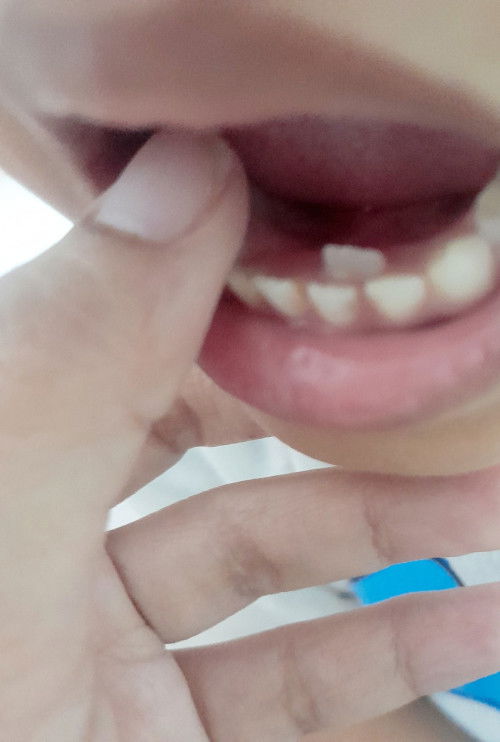 Gigi baru tumbuh dijalur yang lain