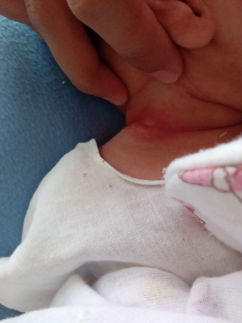 ขอคำแนะนำการดูแลซอกคอลูกน้อย