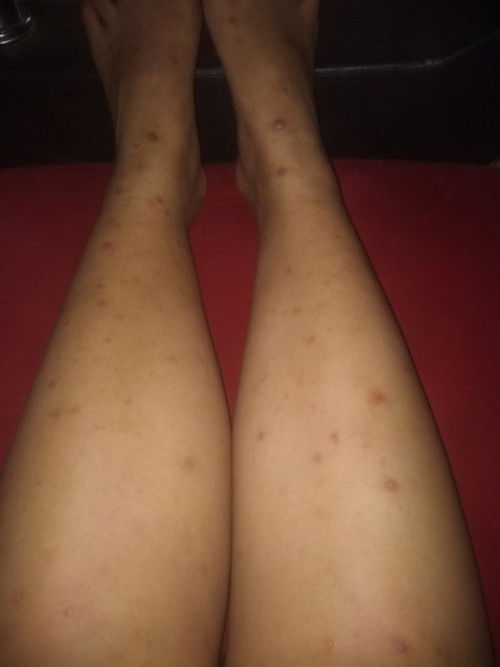 Mau tanya dong bung kaki dan tangan gatel" trus jadi korengan gini cara ilangin nya pake apa ya?