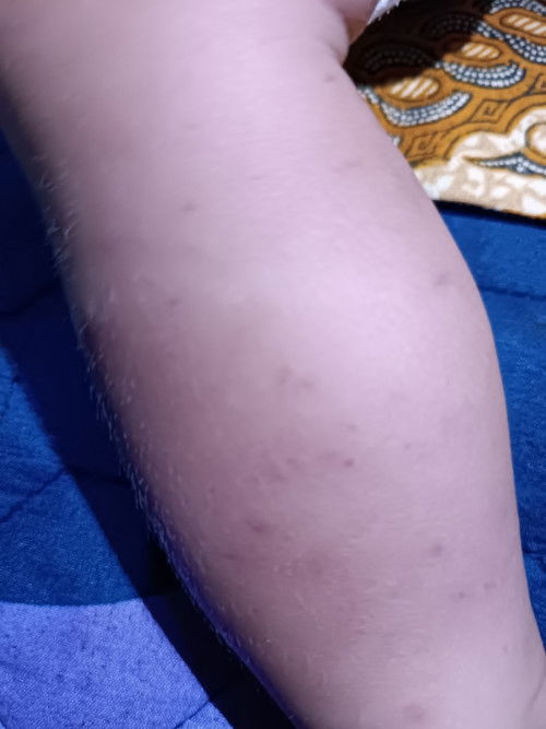Ruam merah di kaki bayi