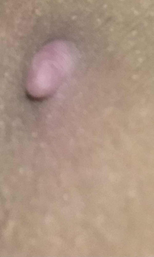 Muncul setelah lahiran