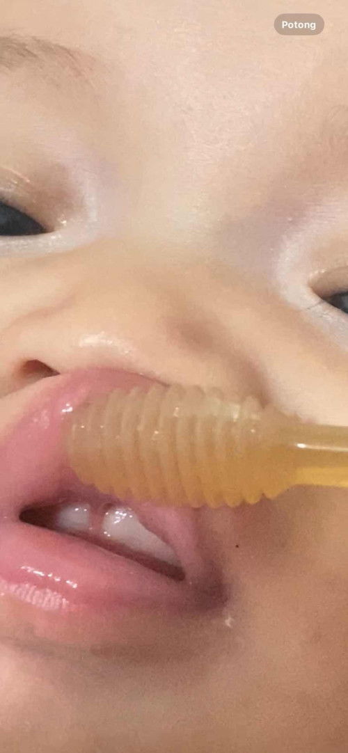 Masalah liptie pada bayi