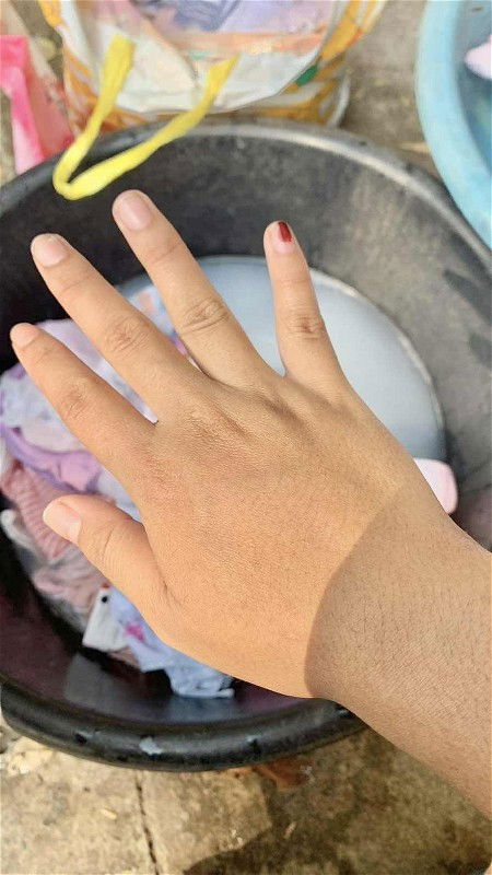 ตื่นเช้ามามือบวมหนักมากใกล้คลอดยังคะ อีกนานไหมคะ