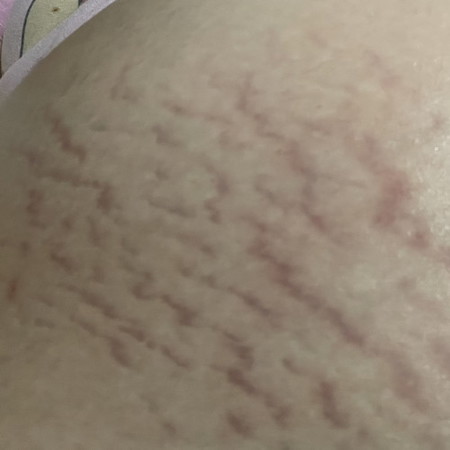 cara hilang kan stretch mark