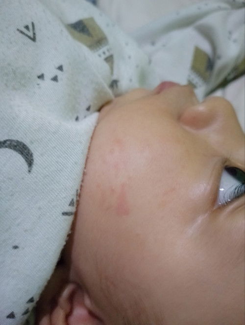 merah merah di wajah