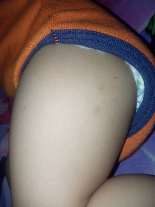 Bekas gigitan nyamuk