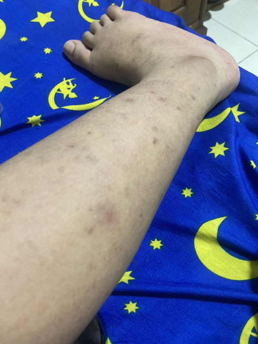 Sya hamil 35 week kaki sya awalnya gatel trus ini tnggal bekasnya ..cra ngilangin bekasnya gmn bun