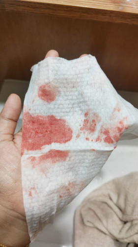 Bleeding at 6 weeks pregnancy