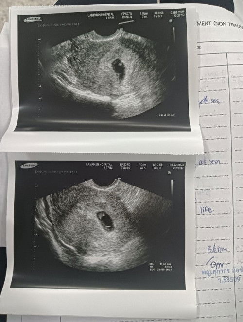 ยาวหน่อยนะคะแม่ๆ ตอนนี้เราเจอสภาวะแท้งคุกคามค่ะ เรามีเลือดออกทางช่องคลอด