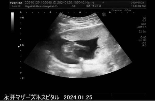 Gender at 16w4d