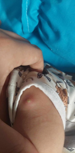 Anyone who know this? Last injection of my newborn when he was 4days old. Seeking help po.