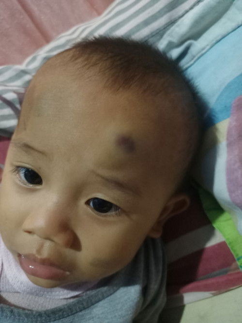 Kepala anak selalu benjol kalo kejedug