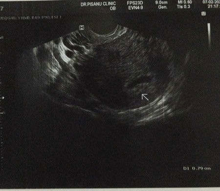 การตั้งครรภ์