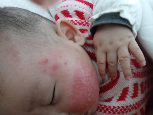 Có bé nào bị viêm da hay ng ta hay nói bị chàm sữa ở mặt k ạ? Bé nhà e bị mf cứ tái đi tái lại.