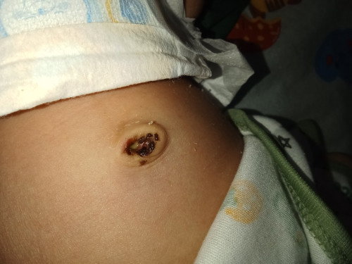 Puput pusar pada bayi