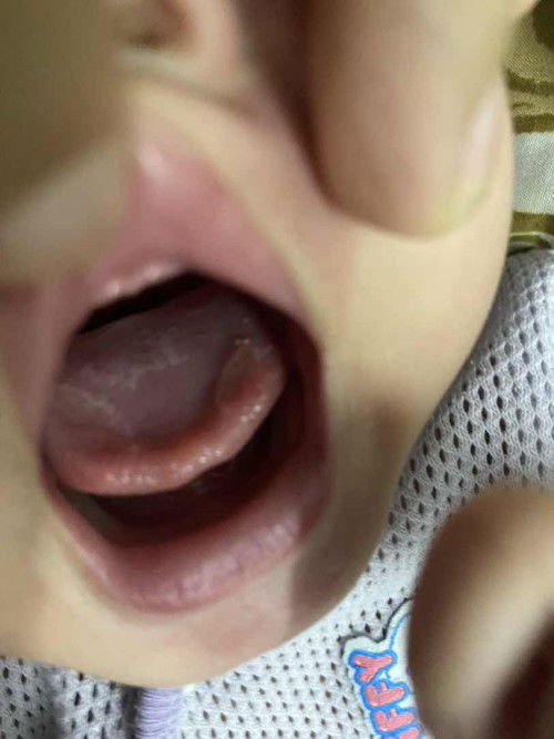 Kulat susu ke atau ulcer lidah?