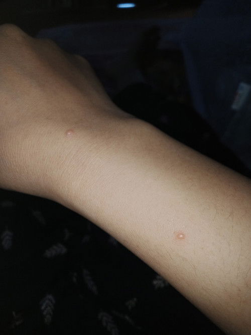 Bentol2 kekgini pasca lahiran kenapa ya bund? Banyak di badan kepala kaki punggung wajah. Semua ada.