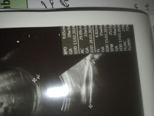 BPD (lingkar kepala) lebih besar