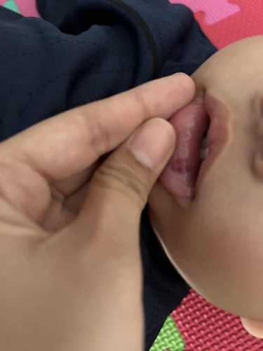 Anak 1 tahun jatuh luka dagu bibir korang letak apa eh nak bagi ok risau pulak kot biar kang kuman