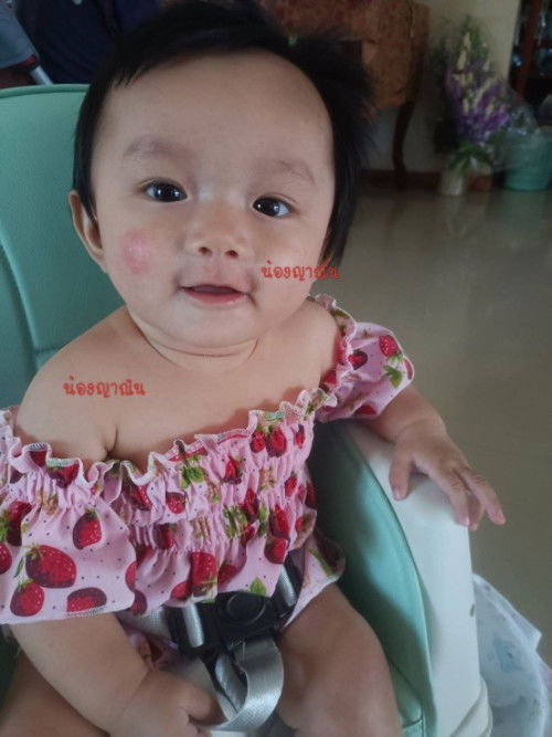 น้องเป็นผื่นแดงที่แก้มเกือบเดือนแล้ว ไม่หายสักที