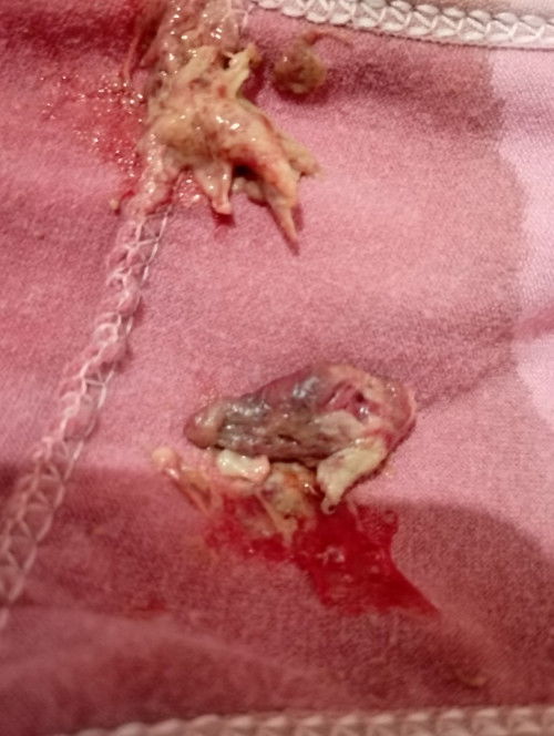 Keluar gumpalan seperti daging setelah 3 minggu melahirkan